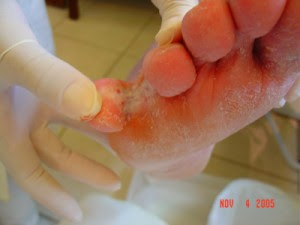 Como curar um fungo em uma virilha em homens um fórum